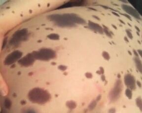 Porn vitiligo Vitiligo Porn
